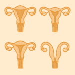 aangeboren baarmoederafwijkingen - Verloskundige Kampen PuurBegni